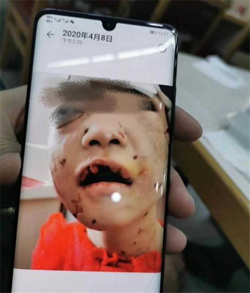 黑龙江虐童父亲被拘 黑龙江女童被虐打事件始末