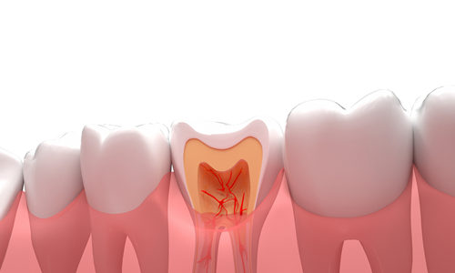 儿童蛀牙有哪些危害 儿童蛀牙治疗方法